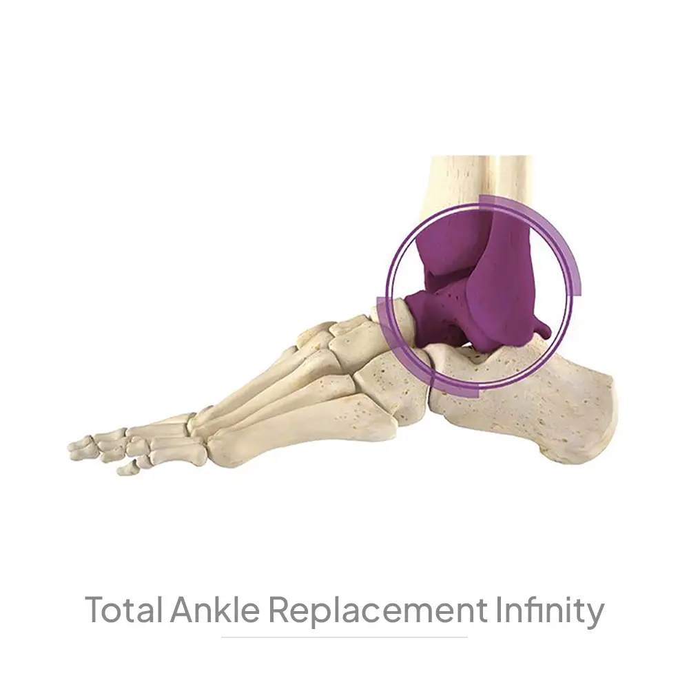 Total Ankle Replacement